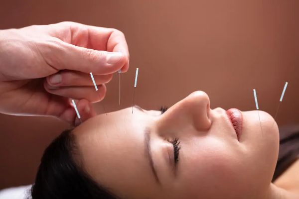Facial Acupuncture For Anti Aging