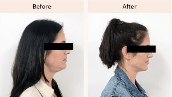 facial-toning-device-before-after