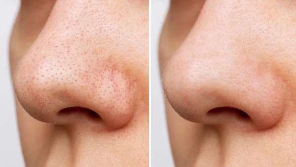 How to Remove Blackheads From Nose DIY