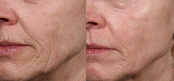 microcoring facelift