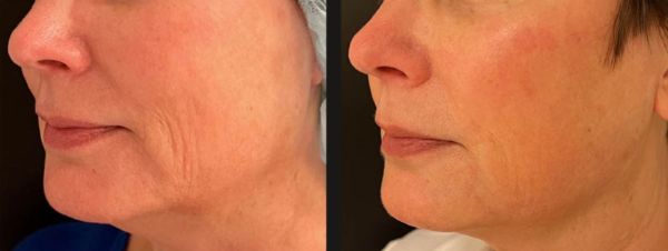non-surgical facelift before after