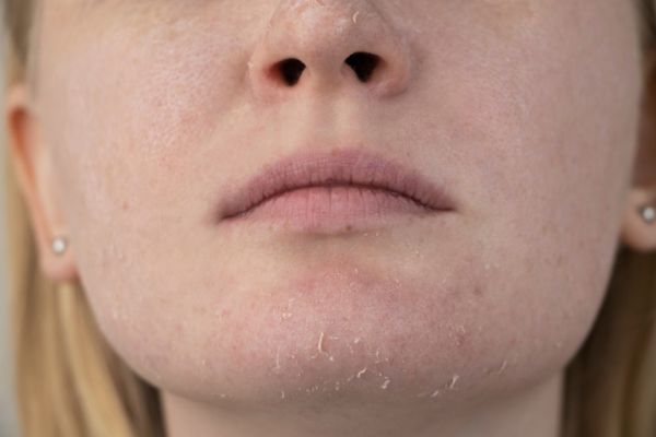 How to Get Rid of Dry Skin on Face