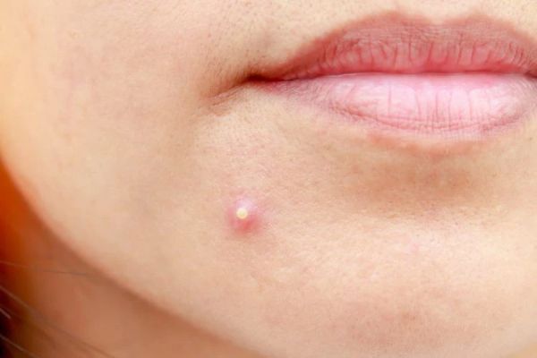 Shrink Pimple Overnight Fast