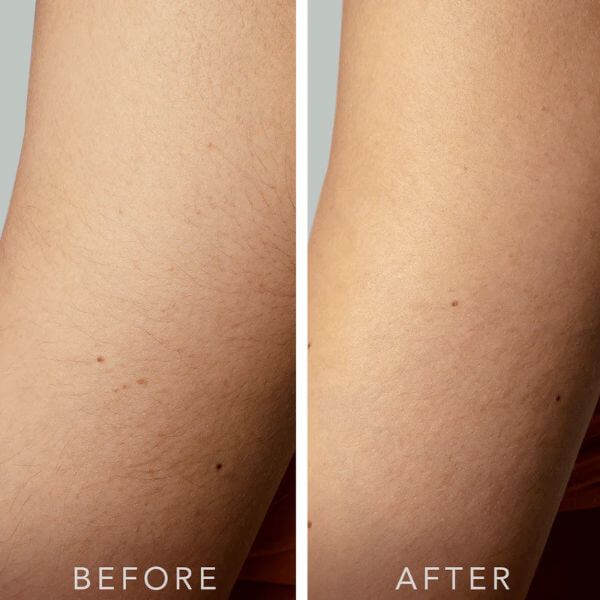 IPL-hair-removal-legs-before-and-after