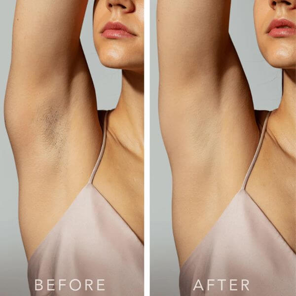 IPL-hair-removal-under-arm-before-and-after