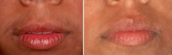 IPL-hair-removal-upper-lips-before-and-after