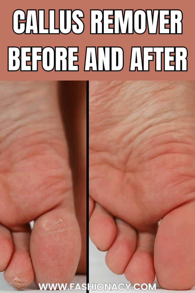 Callus Remover Before and After