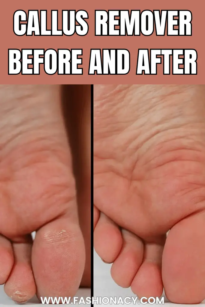 Callus Remover Before and After