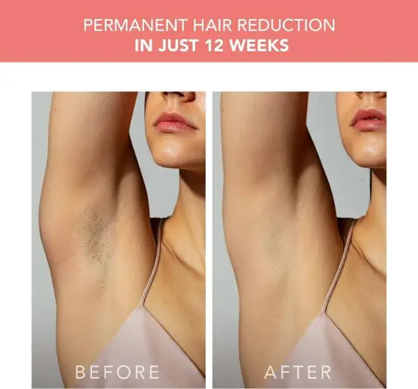 ipl-hair-removal-handset-results