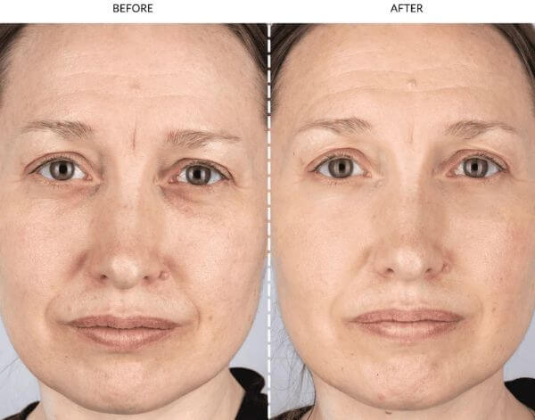 led-light-face-mask-before-and-after
