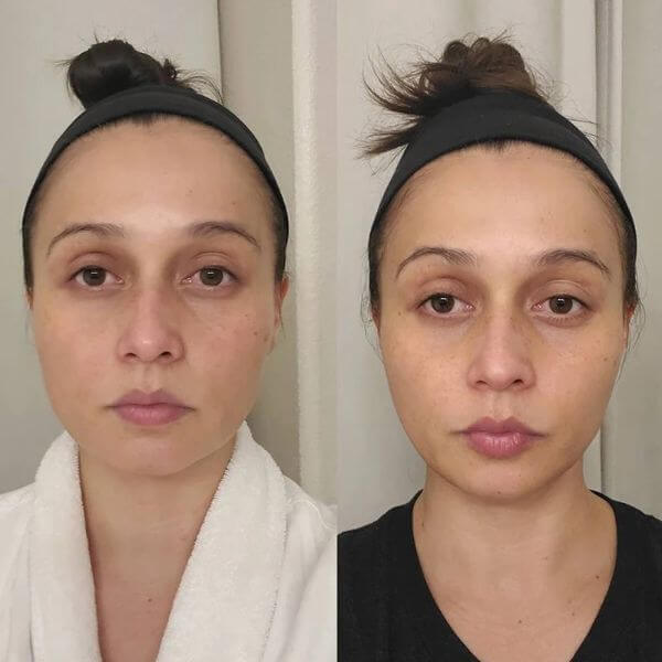 Microcurrent Facial Before and After Results