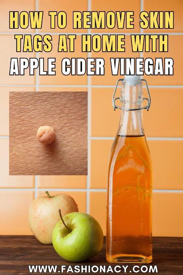 How to Remove Skin Tags at Home With Apple Cider Vinegar