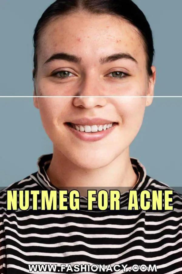 Nutmeg For Acne