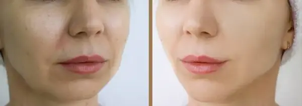 Cortisol Face